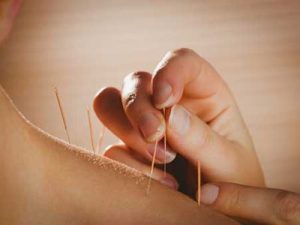 acupuncture Fort Collins